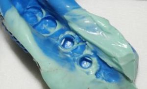 Implants dentaires en forme de «lame»1
