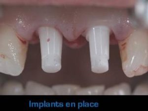 Implants en place