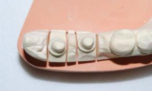 Implants dentaires en forme de «lame»2