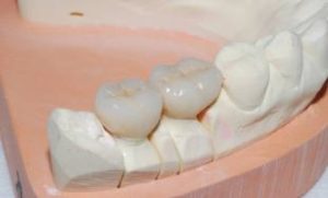 Implants dentaires en forme de «lame»3